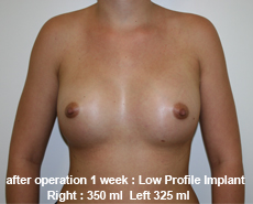 plastic-surgery-breast-augmentation